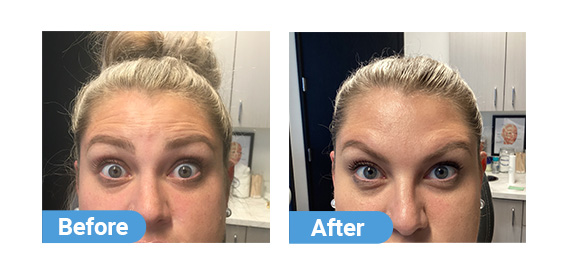 botox injection case 05