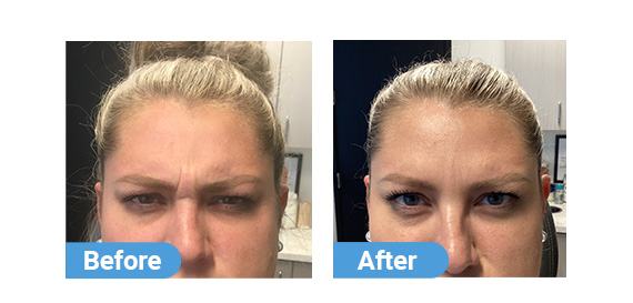 botox injection case 06