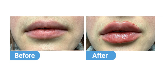 lip filler case 10