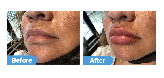 lip filler case 06