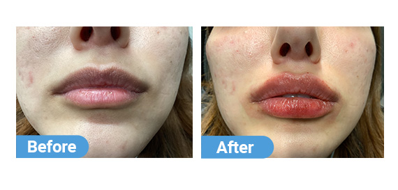 lip-filler-7