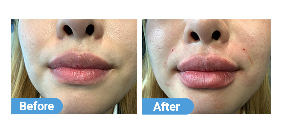 lip filler case 09
