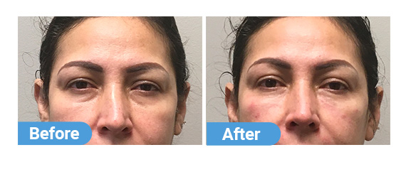 tear-trough-filler-2