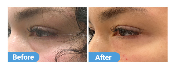 tear-trough-filler-3